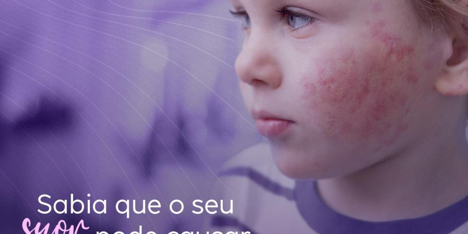Sabia que o seu suor pode causar urticária?
