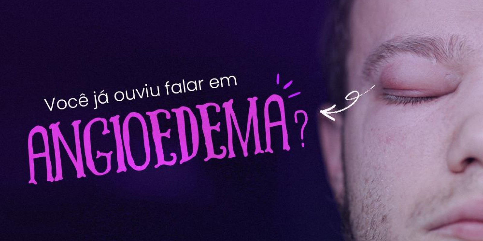 Você já ouviu falar em ANGIODEMA?