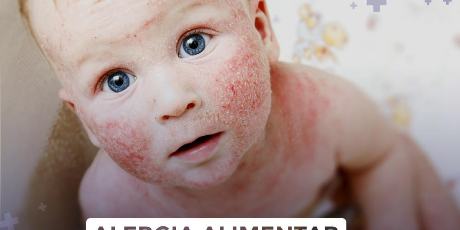 Alergia alimentar nos primeiros meses de vida